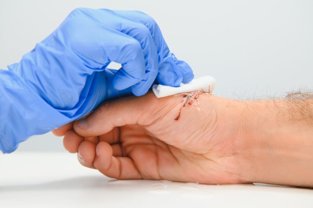 Prevenção e Tratamento de Feridas Cirúrgicas Infectadas