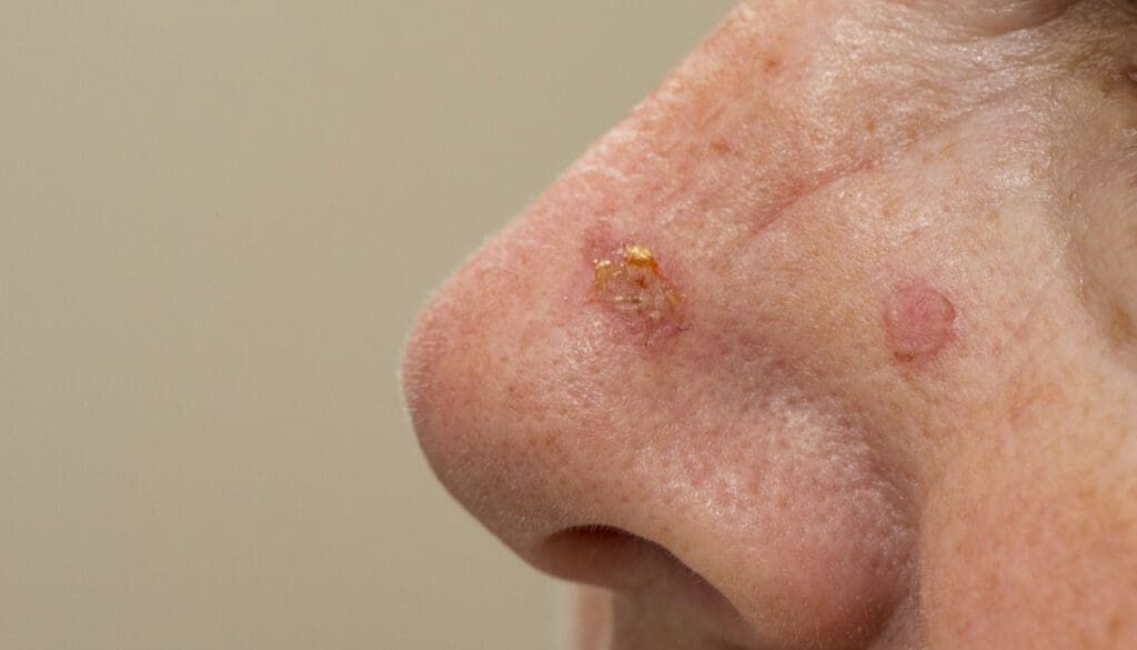 Carcinoma Basocelular: Causas, Diagnóstico e Quando é Grave