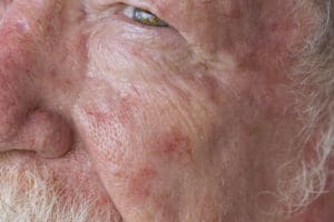 Carcinoma Basocelular: Causas, Diagnóstico e Quando é Grave