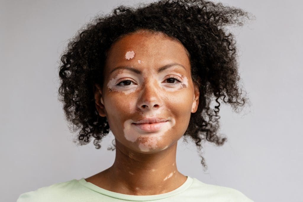 Vitiligo: O Que É, Causas, Sintomas e Tratamentos