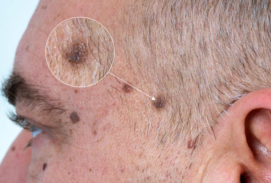 Melanoma: O Que É, Sintomas e Como Identificar