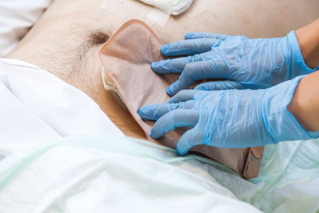 O que é ostomia? Tipos, cuidados e adaptação