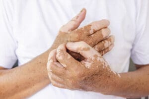 Vitiligo: O Que É, Causas, Sintomas e Tratamentos