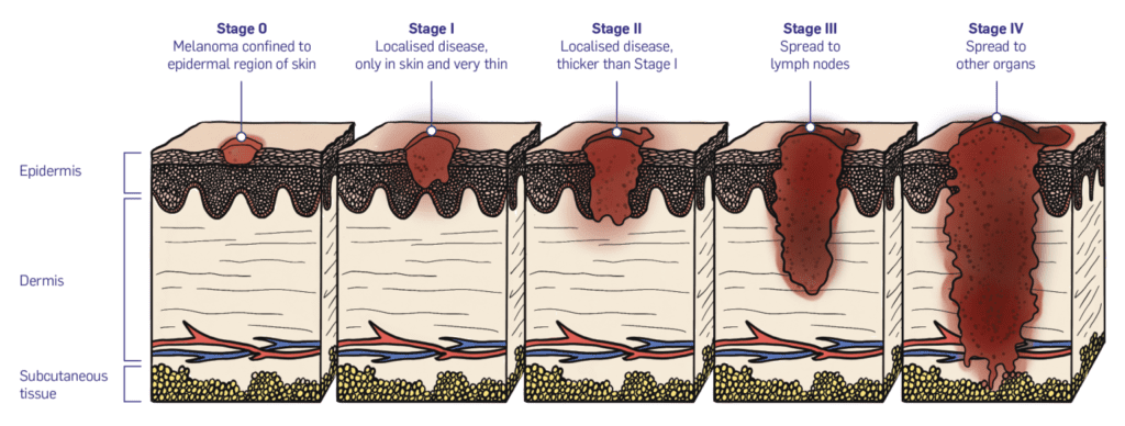 Melanoma: O Que É, Sintomas e Como Identificar