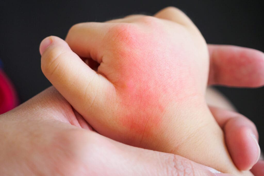 Impetigo: O que é, sintomas e como tratar essa infecção