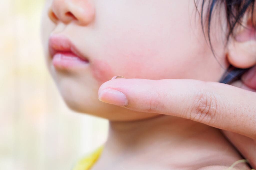 Impetigo: O que é, sintomas e como tratar essa infecção
