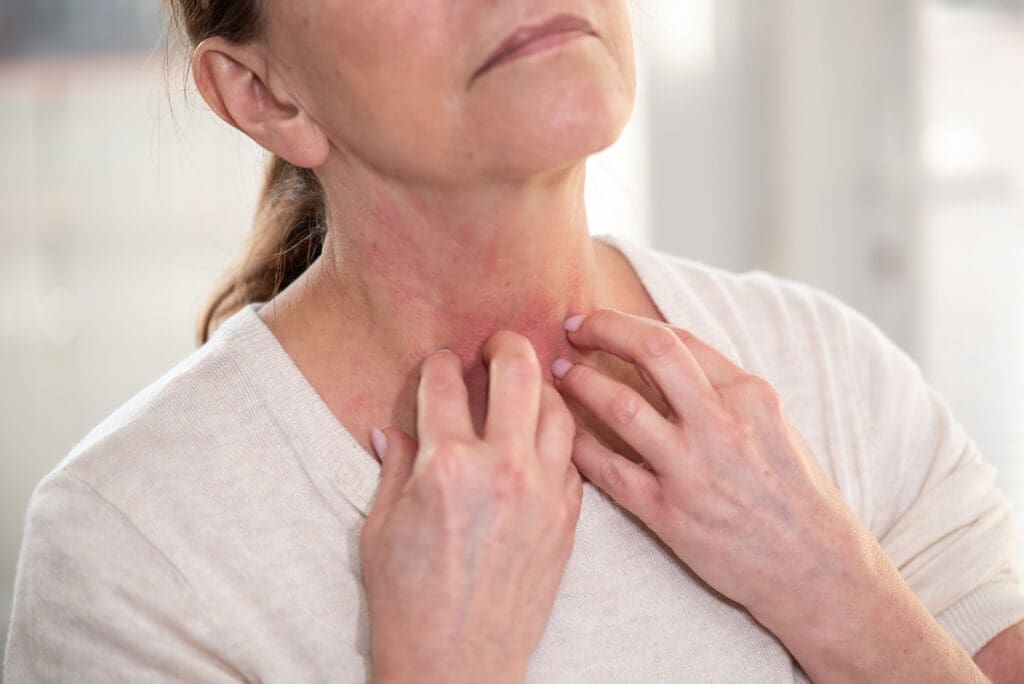 Impetigo: O que é, sintomas e como tratar essa infecção