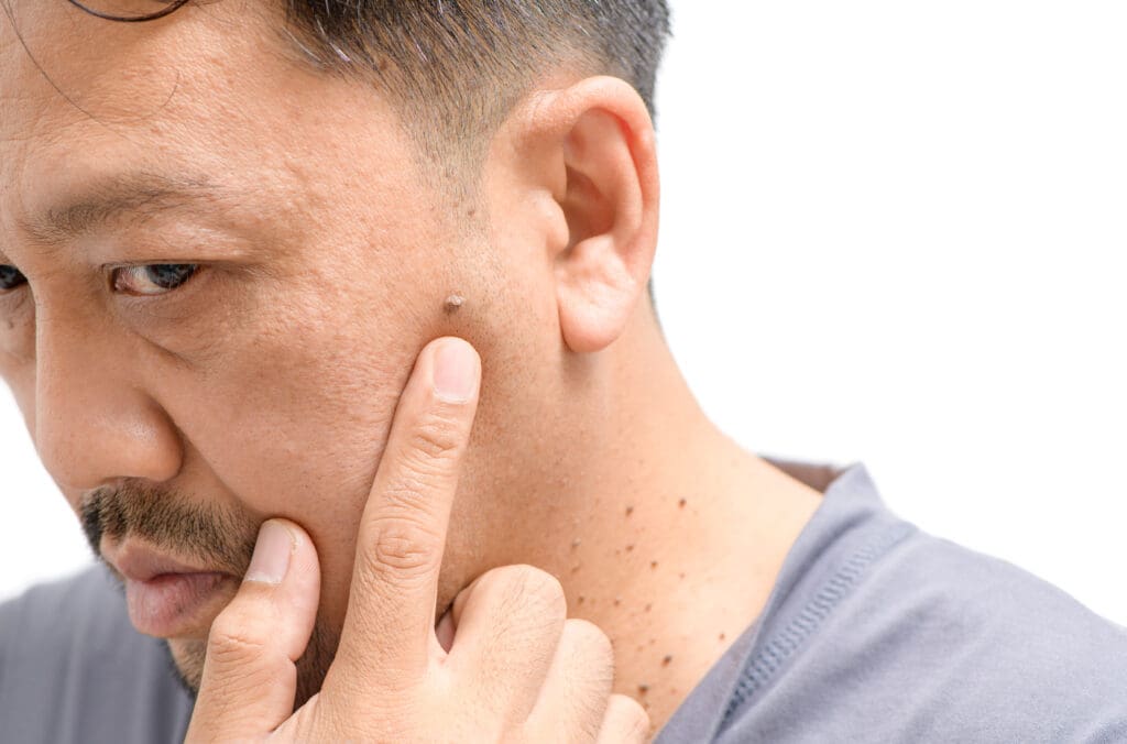 Carcinoma Espinocelular: O Que É, Sintomas e Tratamentos