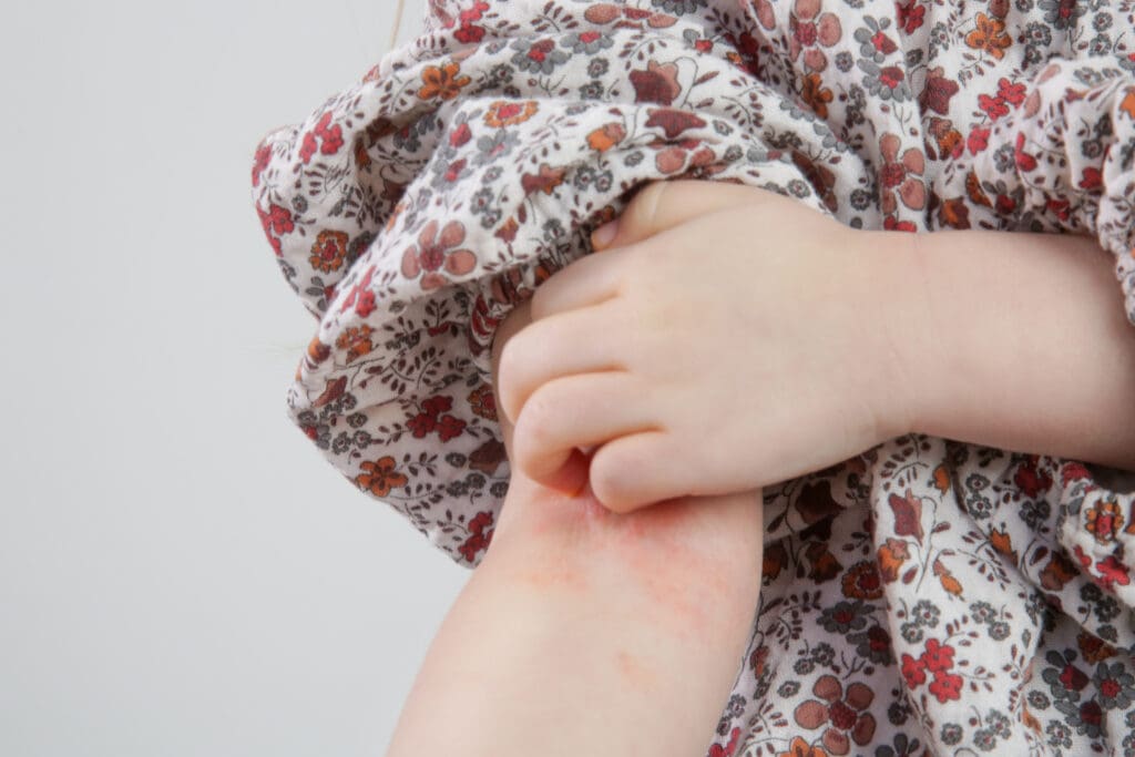 Impetigo: O que é, sintomas e como tratar essa infecção