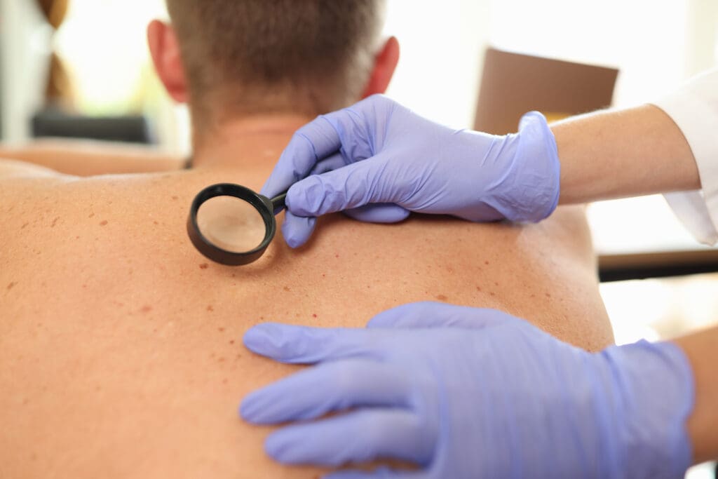 Carcinoma Espinocelular: O Que É, Sintomas e Tratamentos