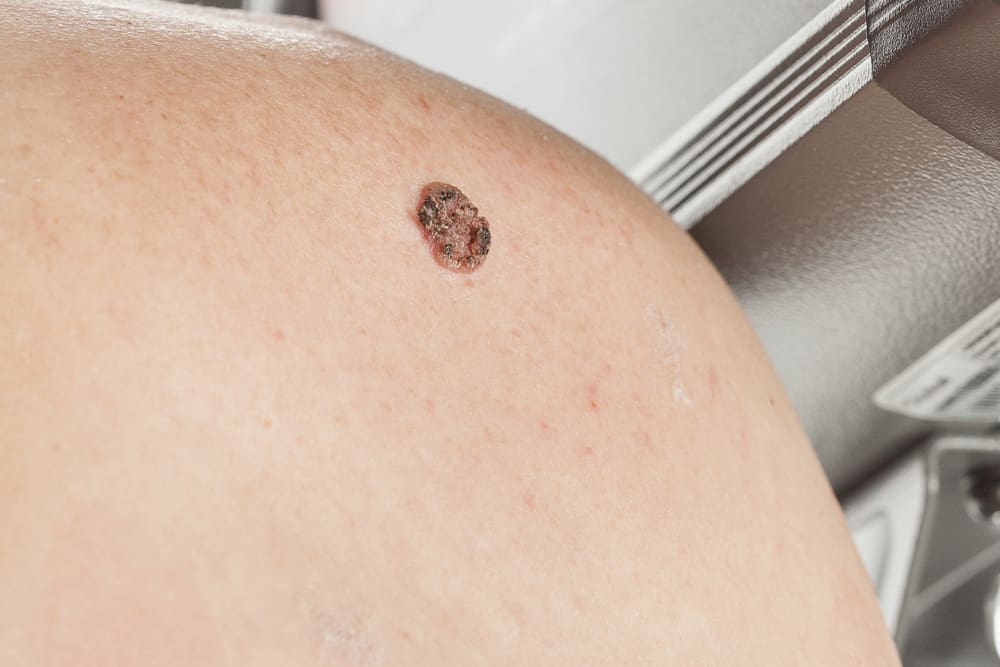 Carcinoma Basocelular: Causas, Diagnóstico e Quando é Grave