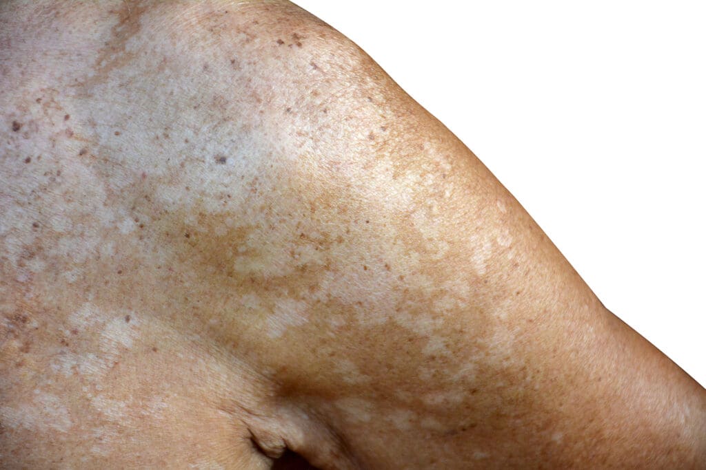 Pitiríase Versicolor: O Que É, Sintomas e Tratamentos