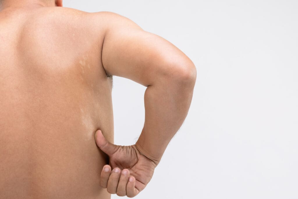 Pitiríase Versicolor: O Que É, Sintomas e Tratamentos
