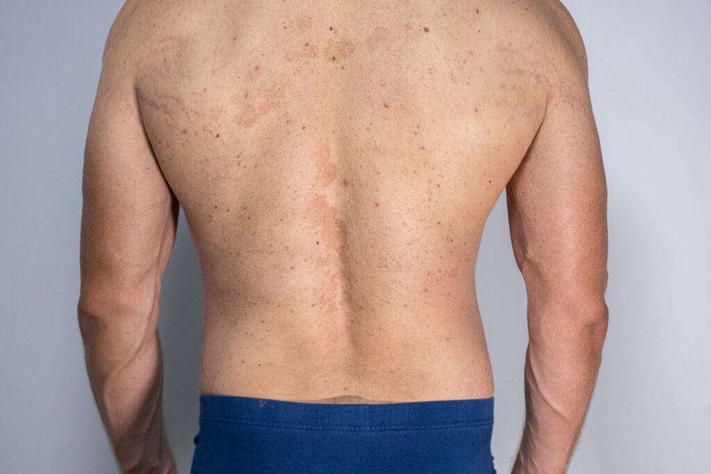 Pitiríase Versicolor: O Que É, Sintomas e Tratamentos