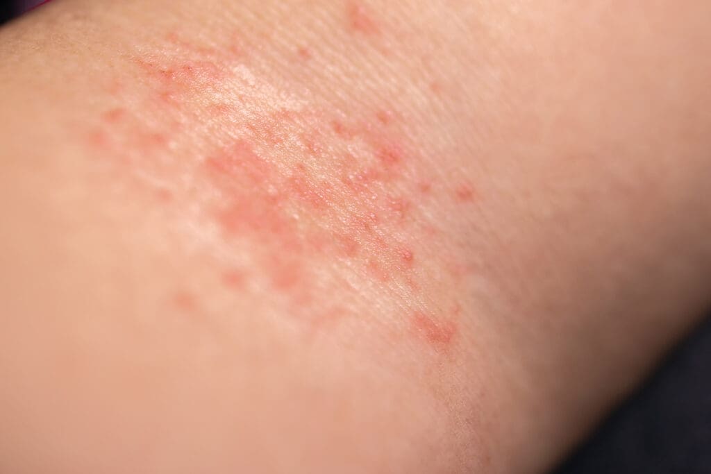 Coceira no Corpo Todo? Veja as Principais Causas e Soluções