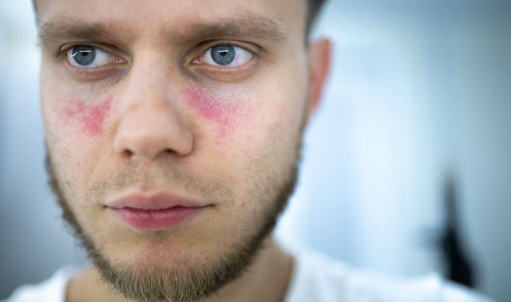 Rubor Facial: O Que É, Causas e Como Tratar