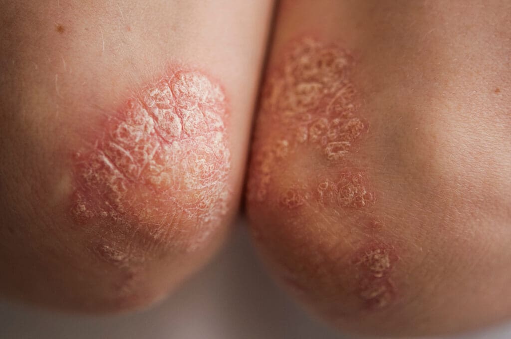 Coceira no Corpo Todo? Veja as Principais Causas e Soluções