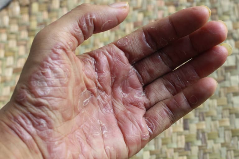A coragem de Preta Gil e os cuidados essenciais com a pele após o câncer