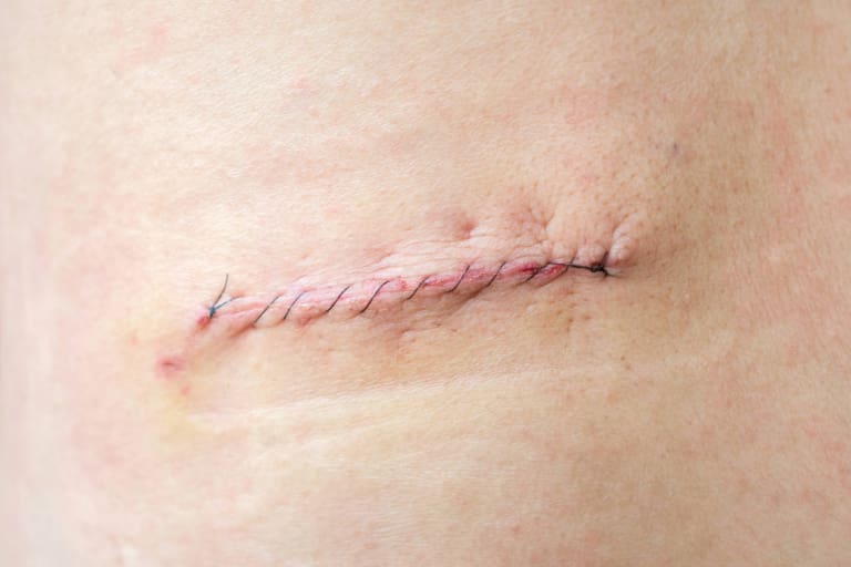 Como estão os cuidados com a pele e cicatrização após a última cirurgia abdominal de Bolsonaro?