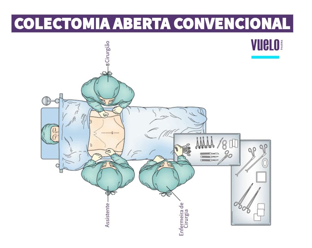 Colectomia: o que é, tipos, riscos e recuperação