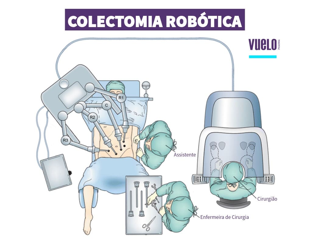 Colectomia: o que é, tipos, riscos e recuperação