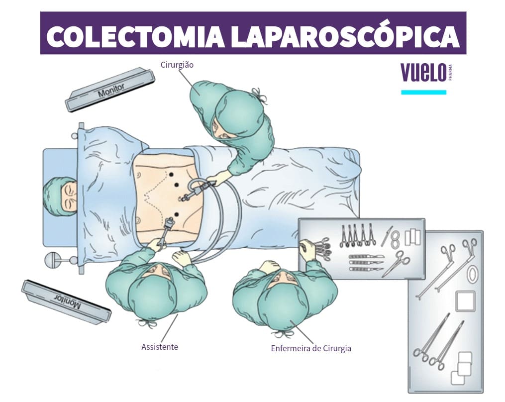 Colectomia: o que é, tipos, riscos e recuperação