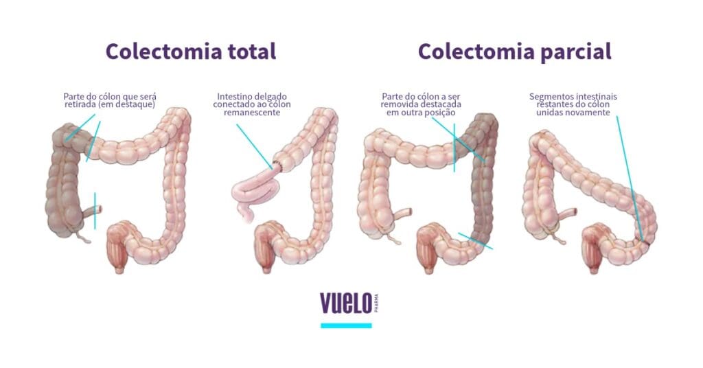 Colectomia: o que é, tipos, riscos e recuperação