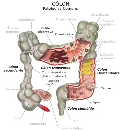 Colectomia: o que é, tipos, riscos e recuperação