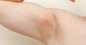 Íngua na Axila: O Que Pode Ser e Como Tratar?