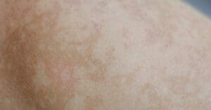 Manchas Brancas na Pele: Causas, Doenças e Tratamentos