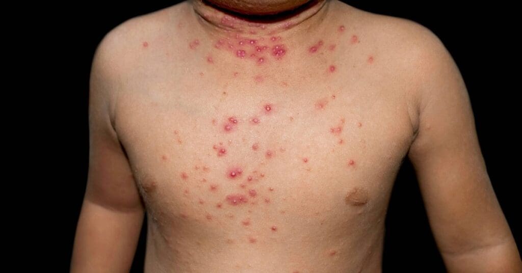 Molusco contagioso: o que é, como identificar e cuidar com carinho