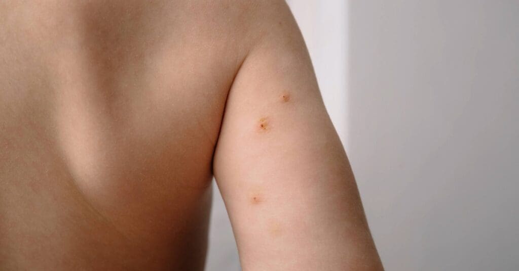 Molusco contagioso: o que é, como identificar e cuidar com carinho