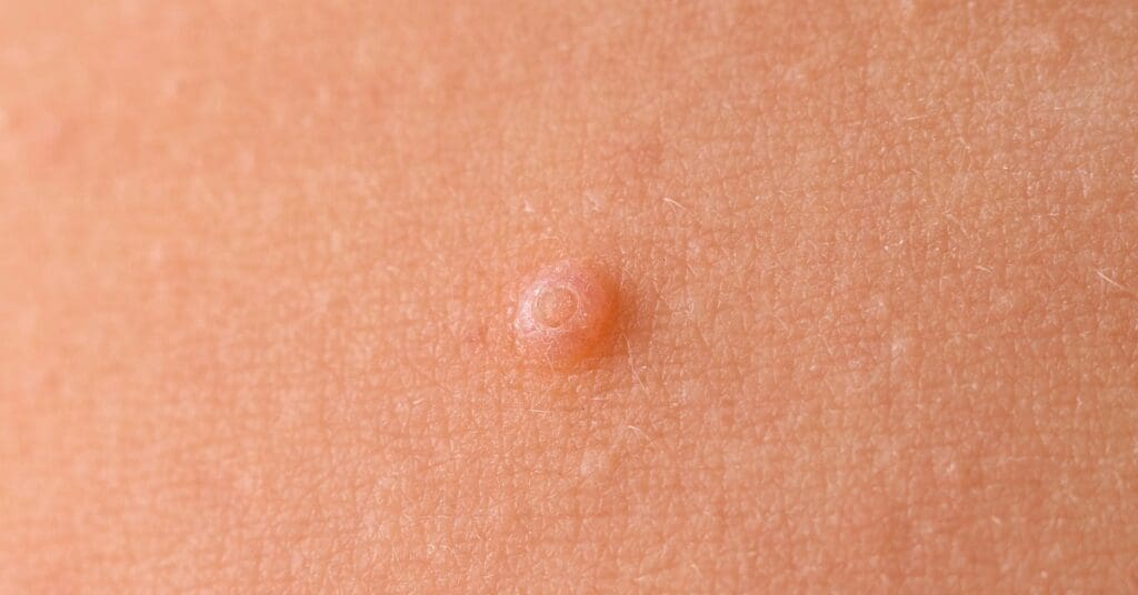 Molusco contagioso: o que é, como identificar e cuidar com carinho