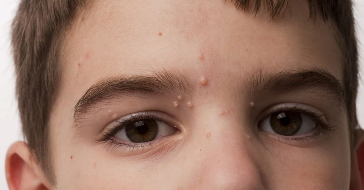 Molusco contagioso: o que é, como identificar e cuidar com carinho