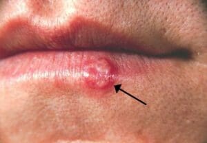 Herpes: o que é, como identificar e cuidar com acolhimento e informação