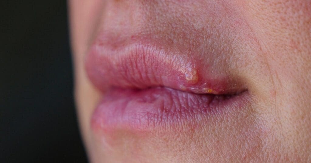 Herpes: o que é, como identificar e cuidar com acolhimento e informação