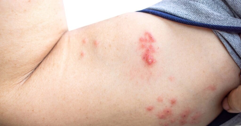 Herpes: o que é, como identificar e cuidar com acolhimento e informação