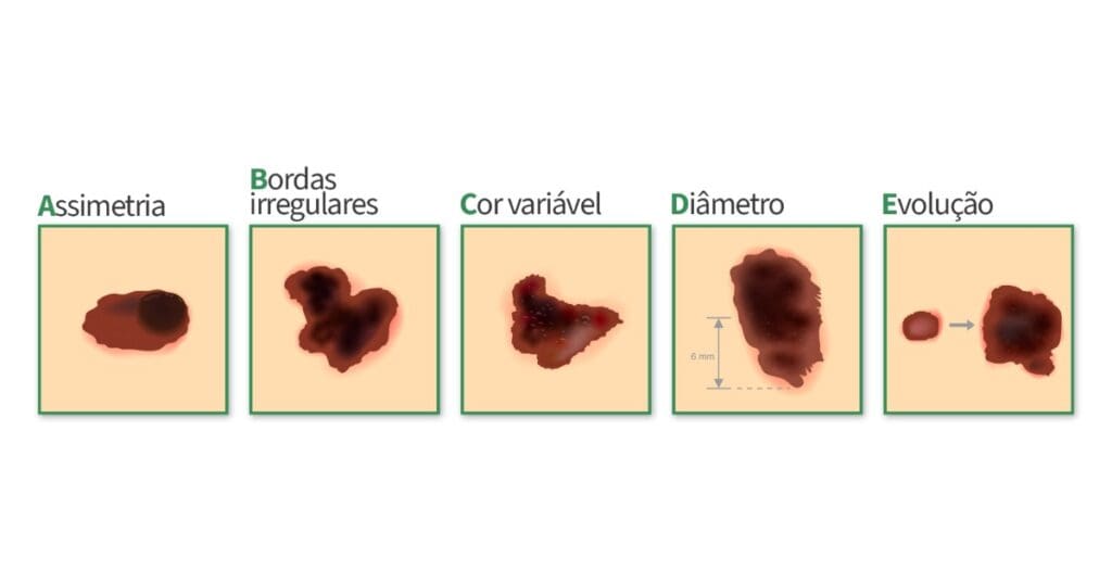 Câncer de Pele: Como Identificar e Prevenir