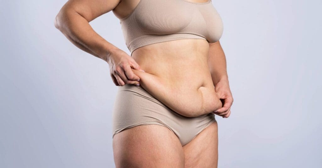Barriga de avental: causas, impactos e como tratar