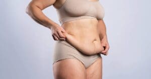 Barriga de avental: causas, impactos e como tratar