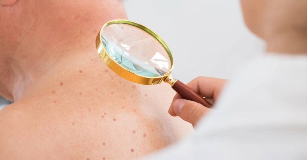 Câncer de Pele: Como Identificar e Prevenir