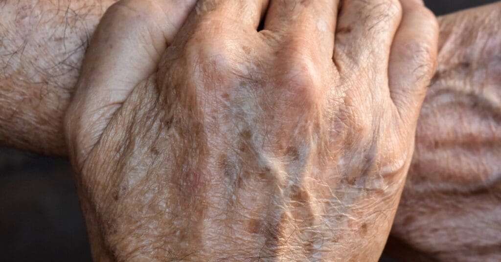 Câncer de Pele: Como Identificar e Prevenir