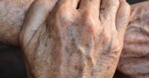 Câncer de Pele: Como Identificar e Prevenir