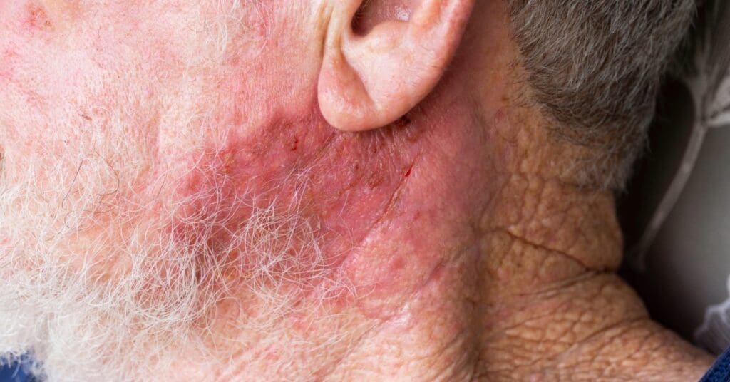 Câncer de Pele: Como Identificar e Prevenir