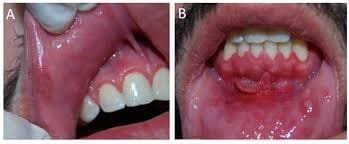 O que é vasculite cutânea? Conheça os sinais e como tratar