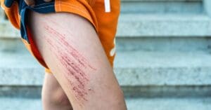 Corte ou arranhão na pele: como agir e evitar infecções