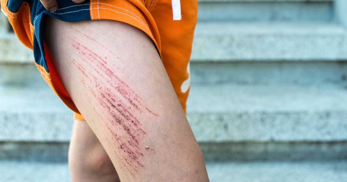 Corte ou arranhão na pele: como agir e evitar infecções