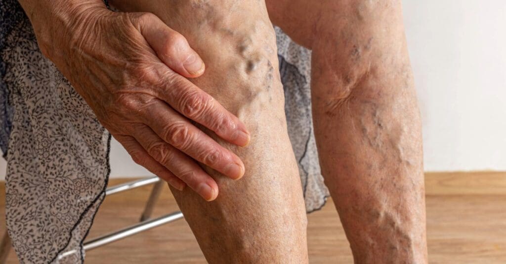 Saúde Vascular: como prevenir doenças circulatórias