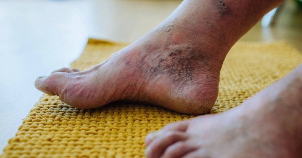 Saúde Vascular: como prevenir doenças circulatórias