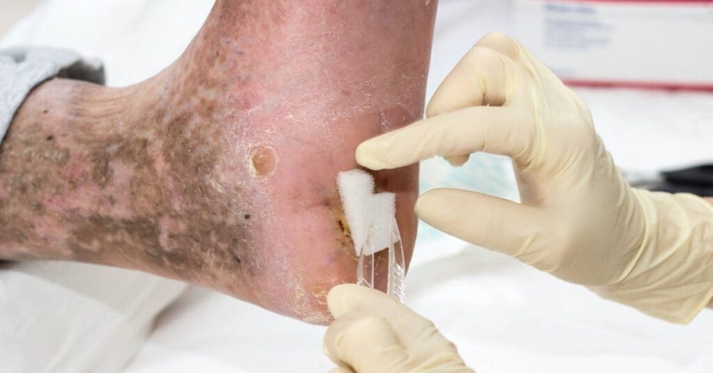 Úlcera Neuropática: Causas, Tratamento e Cuidados Essenciais